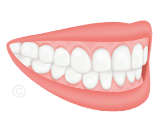 Schéma d'une occlusion dentaire normale (classe I) — orthodontiste Rueil-Malmaison