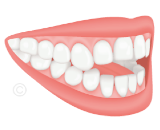 Schéma d'une infraclusion : les dents antérieures ne se touchent pas