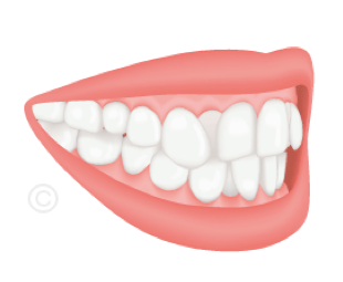 Schéma d'un encombrement dentaire : chevauchement des dents par manque de place