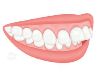 Schéma d'un surplomb horizontal (classe II) — malocclusion dentaire