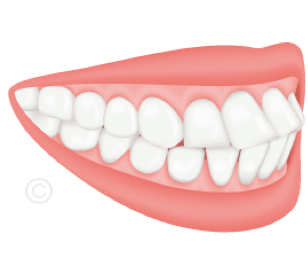 Schéma d'une protrusion : dents antérieures penchées vers l'avant