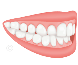 Schéma d'une occlusion croisée : dents inférieures en position inversée
