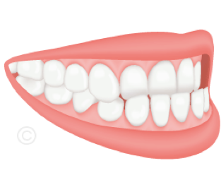 Schéma d'une prognathie : dents inférieures avancées par rapport aux supérieures